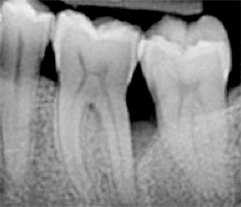 Chirurgische PA-Therapie