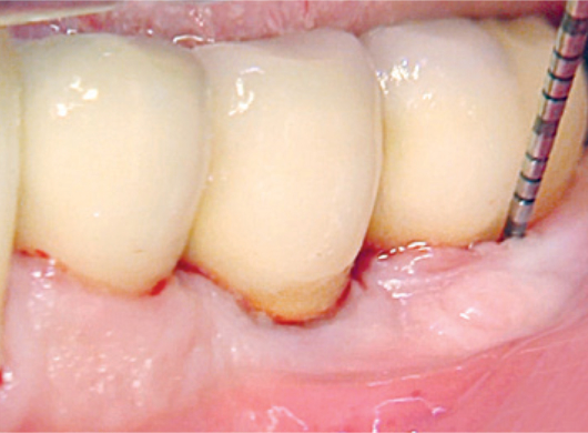 Case Report Clean & Seal