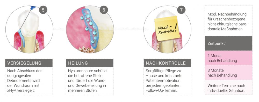 Nichtchirurgische PA-Therapie