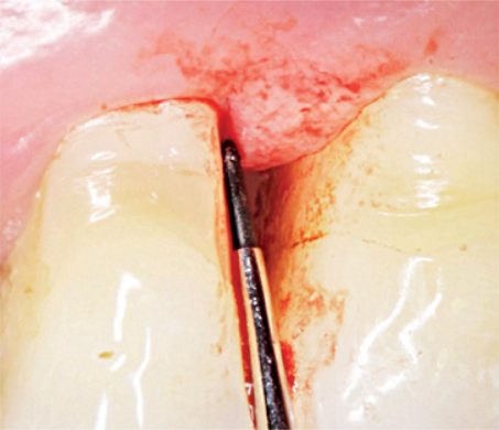 Nichtchirurgische PA-Therapie