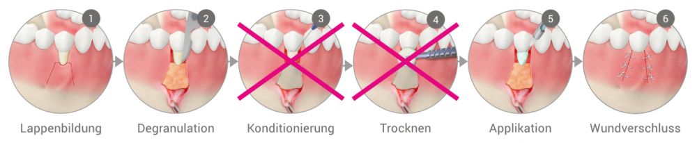 Rezessionsdeckung / Plastisch-Ästhetische Chirurgie