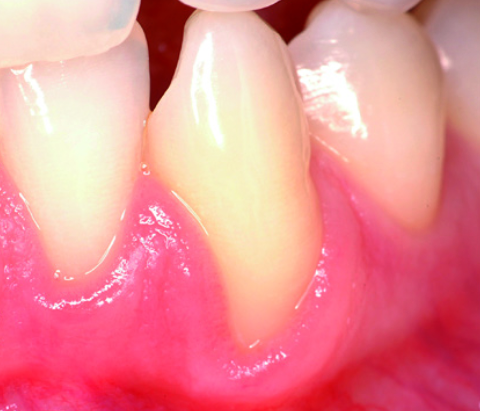 Rezessionsdeckung / Plastisch-Ästhetische Chirurgie