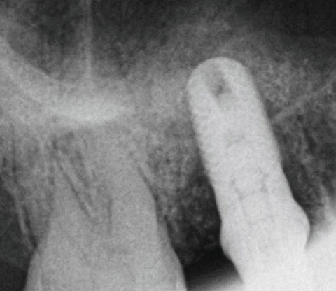 Bild Regedent OSSIX BONE Case Report 3