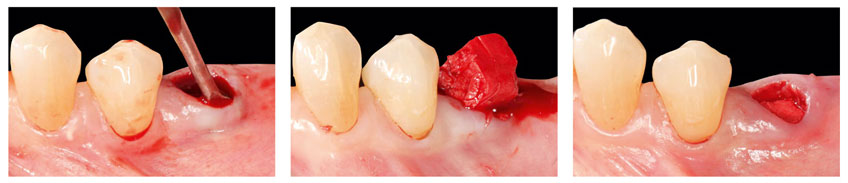 Bild Regedent OSSIX BONE Vorteile