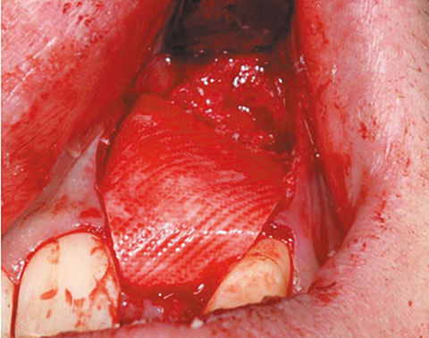 Bild OSSIX PLUS Case Report 1