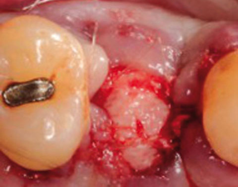 Bild Regedent OSSIX PLUS Case Report 2