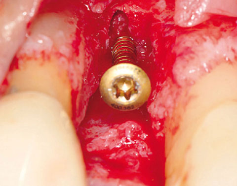 Bild Regedent OSSIX PLUS Case Report 4