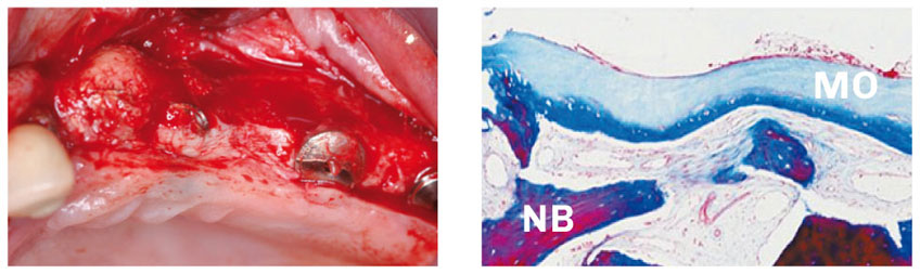 Bild OSSIX PLUS Vorteile