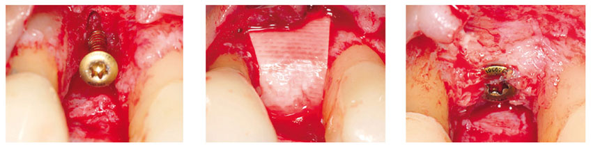 Bild OSSIX PLUS Vorteile