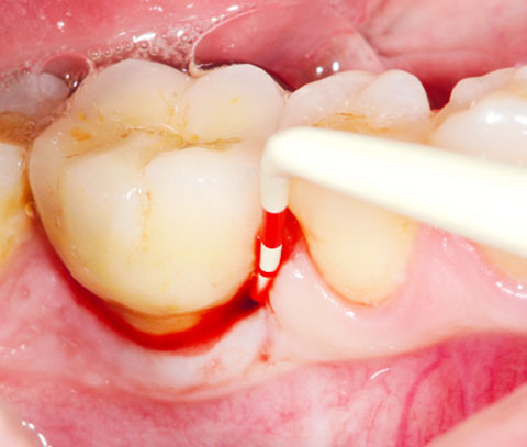 Bild Regedent PERISOLV Case Report 3