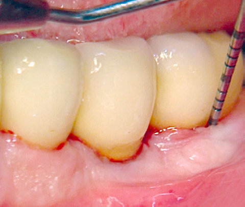 Bild Regedent PERISOLV Case Report 4