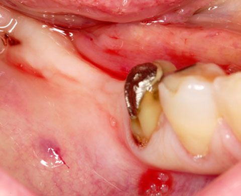 Bild OSSIX SMARTBRANE Case Report 1