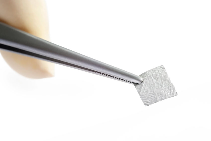 Bild OSSIX SMARTBRANE Indikationen