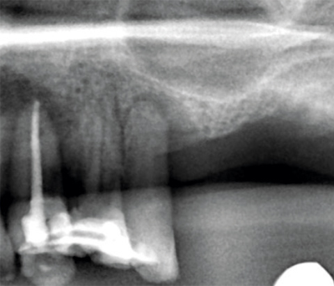 Regedent SMARTGRAFT Case Report 1