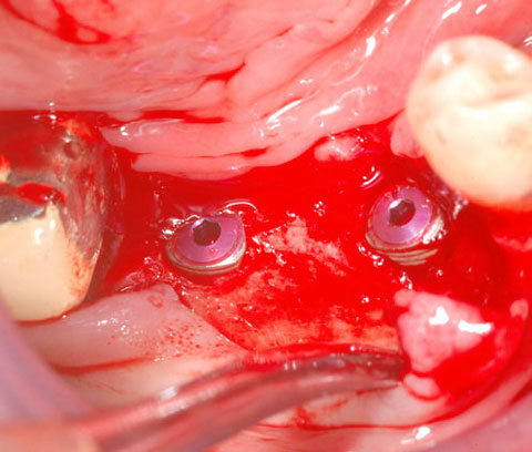 Bild Regedent OSSIX VOLUMAX Case Report 2