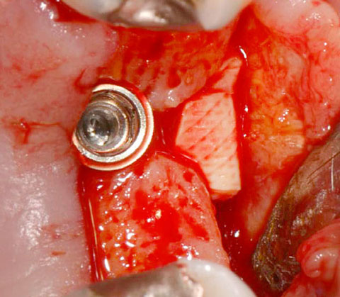 Bild Regedent OSSIX VOLUMAX Case Report 3