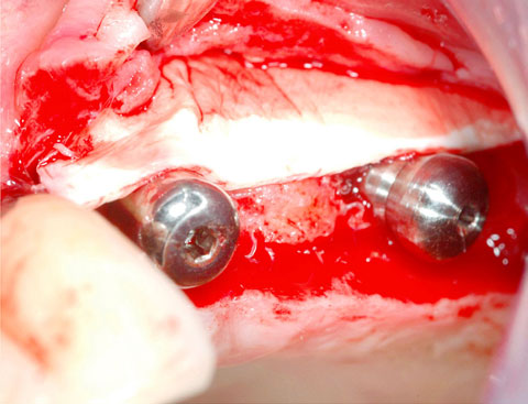 Bild Regedent OSSIX VOLUMAX Vorteile