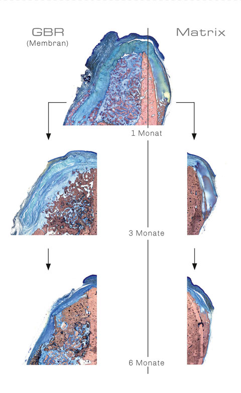 Bild Regedent OSSIX VOLUMAX Vorteile